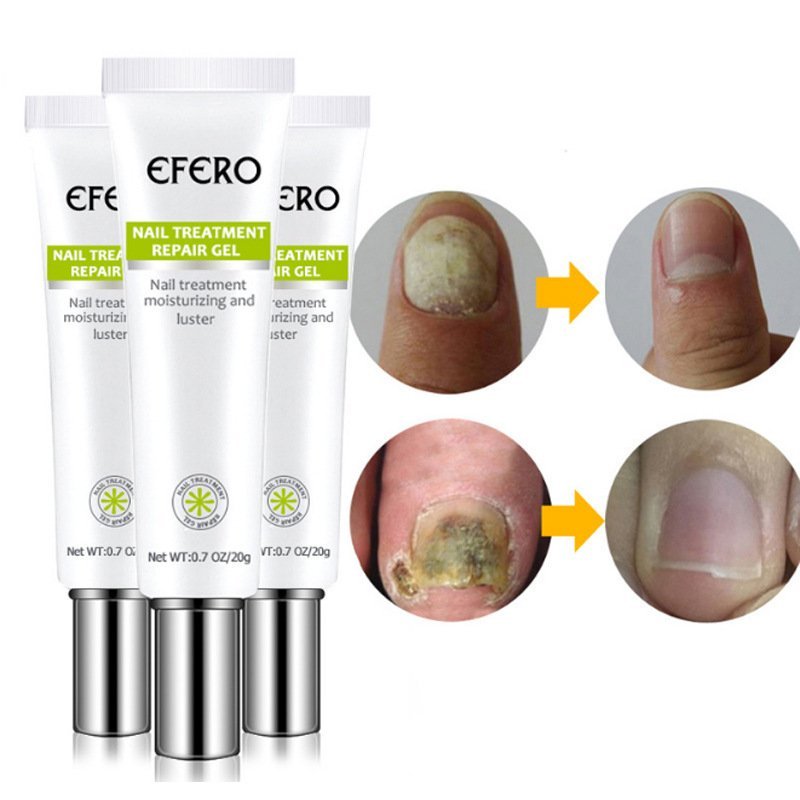 Nail Treatment Serum Nail Foot Nail Fungus Removal Gel Anti Infection Onychomycosis Nail Repair Essence Cream Feet Care - Image 3